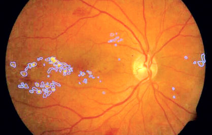 تشخیص بیماری چشمی ناشی از دیابت با هوش مصنوعی