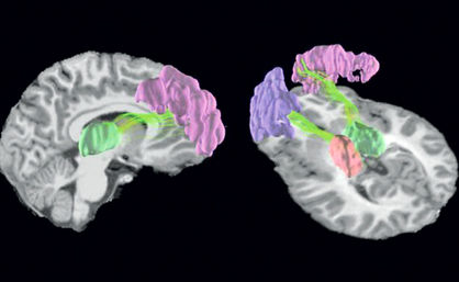 تغییر ساختار مغز با فوتبال بازی کردن