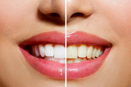 برای داشتن دندان‌های سفید این چند روش خانگی و ساده را امتحان کنید