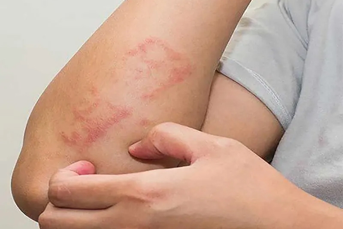بیماری‌های پوستی کودکان مبتلا به اگزما را بیشتر تهدید می‌کند
