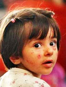 داروهای بیماران پروانهای رایگان شد