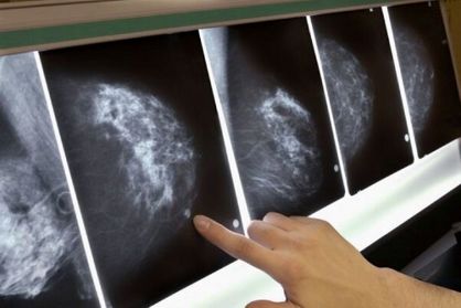 فاکتور احتمالی سرطان سینه شناسایی شد