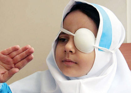 شناسایی ۱۹ هزار کودک دچار «تنبلی چشم» در کشور