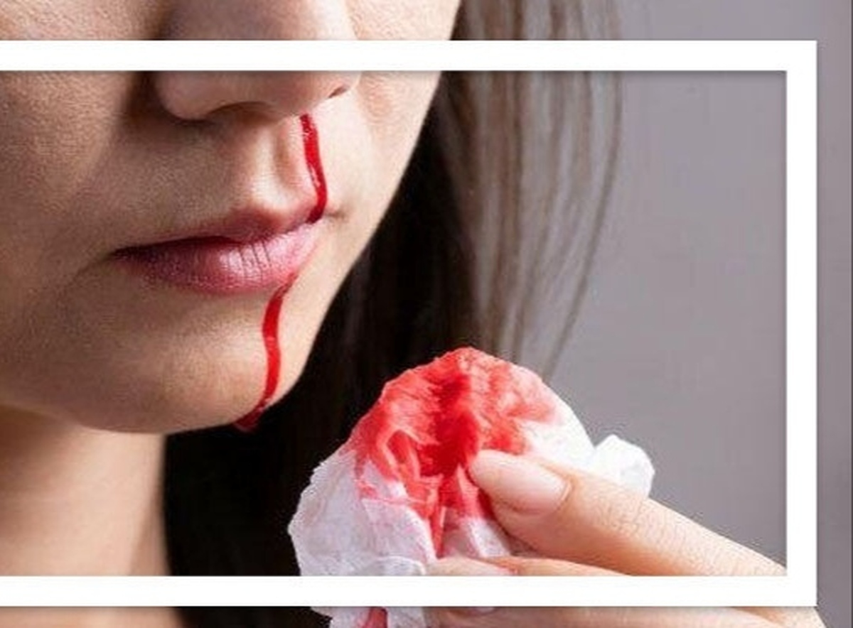 اگر خونریزی بینی دارید دچار این اختلال جدی هستید