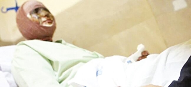 زنگ خطر سوختگي در ايران؛ سالانه ۳۰۰ هزار مصدوم، ۸  برابر ميانگين جهاني