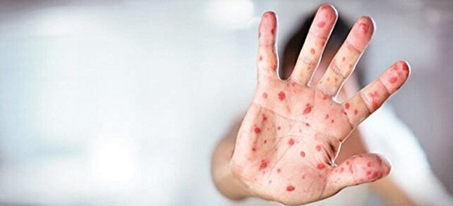 شناسايي ۶۷۴  ابتلا به سرخك در سال گذشته