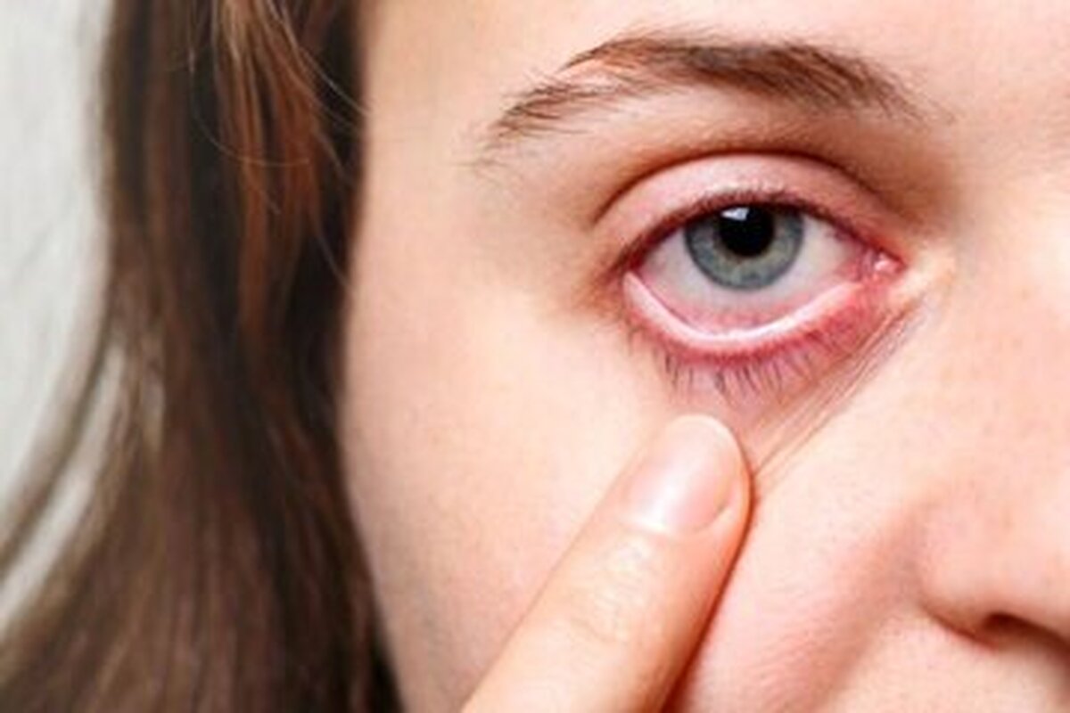 چشم هم سکته می‌کند؟