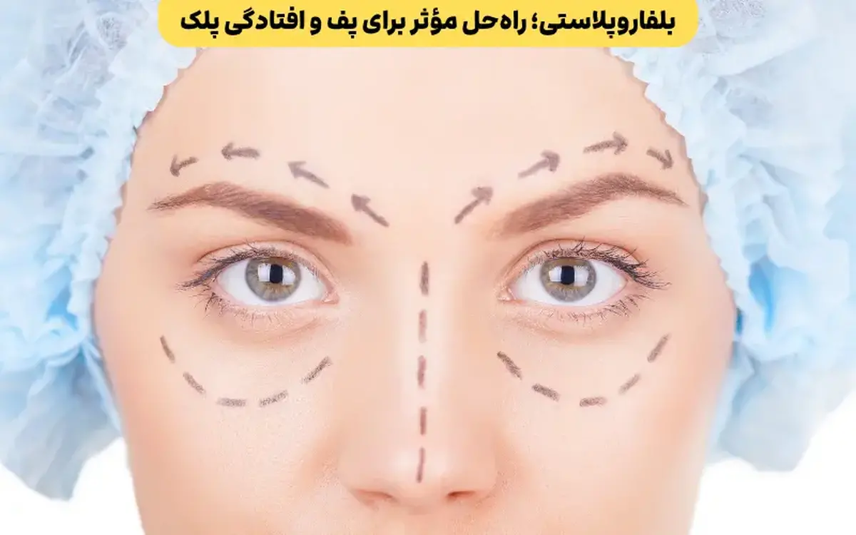 بلفاروپلاستی؛ راهحل مؤثر برای پف و افتادگی پلک